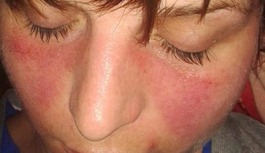 Molar rash on Lupus Patient.